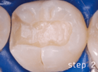 歯の形を調整
