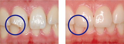 前歯の治療例